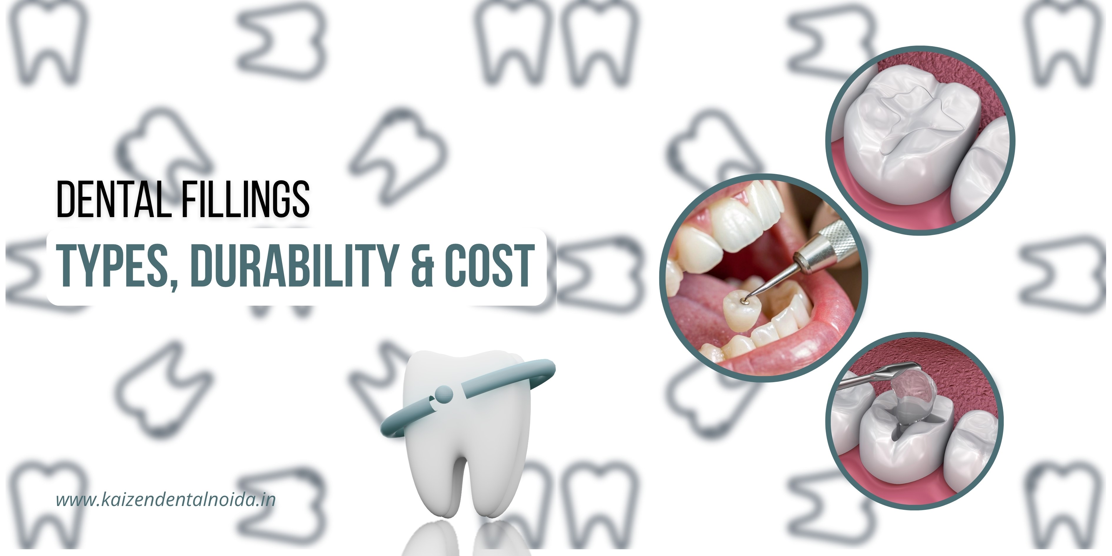 Dental-filling-procedure-showing-composite-material-restoring-decayed-tooth-at-Kaizen-Dental-Noida